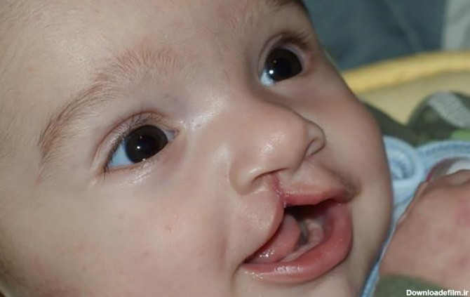 Children with Cleft Palate Receive Complimentary Surgery in Kabul for 10 Days